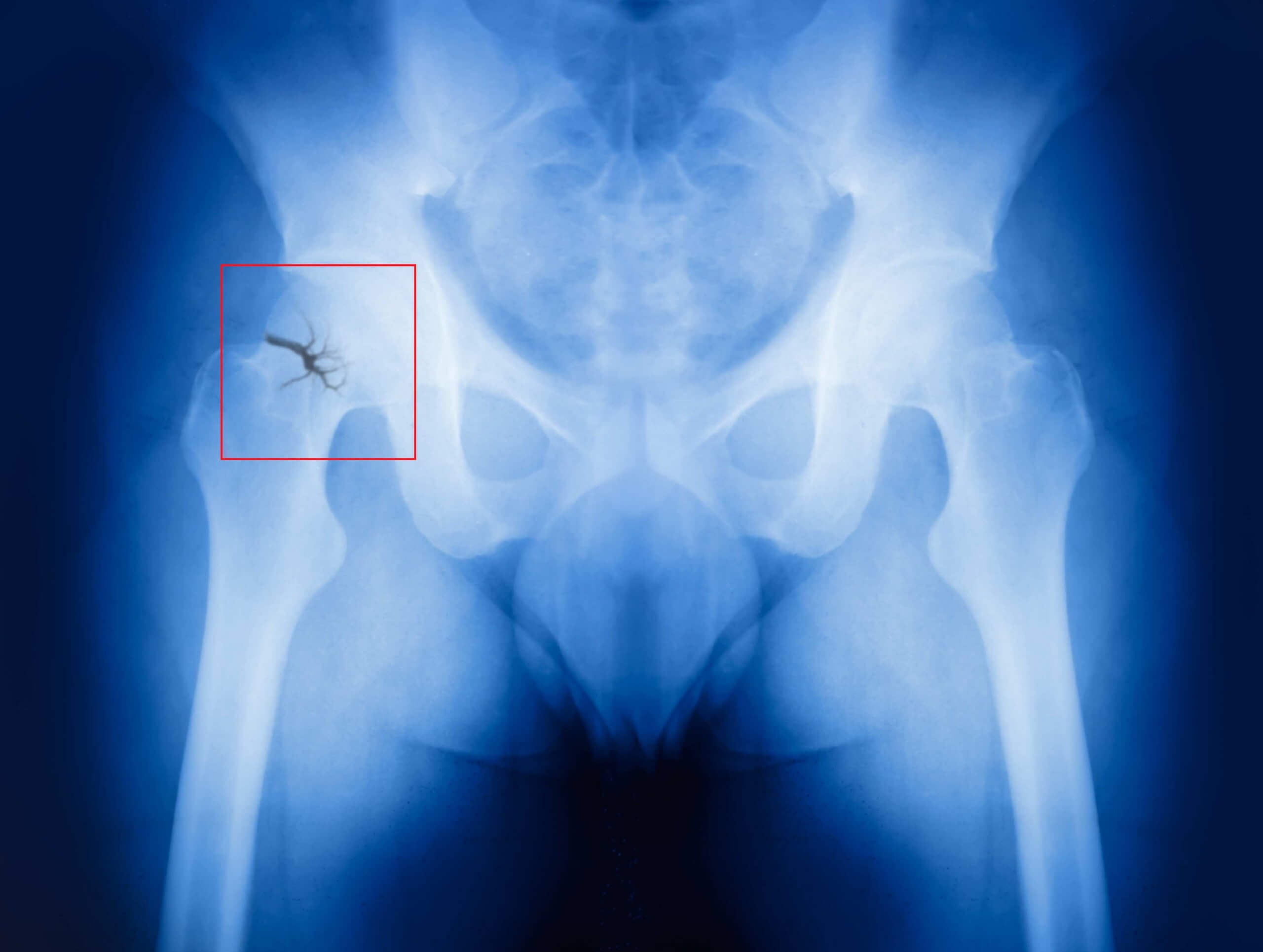 broken hip x ray