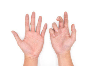 Palm-up view of two hands: the right features the curled fingers typical of Dupuytren’s contracture, the left does not.