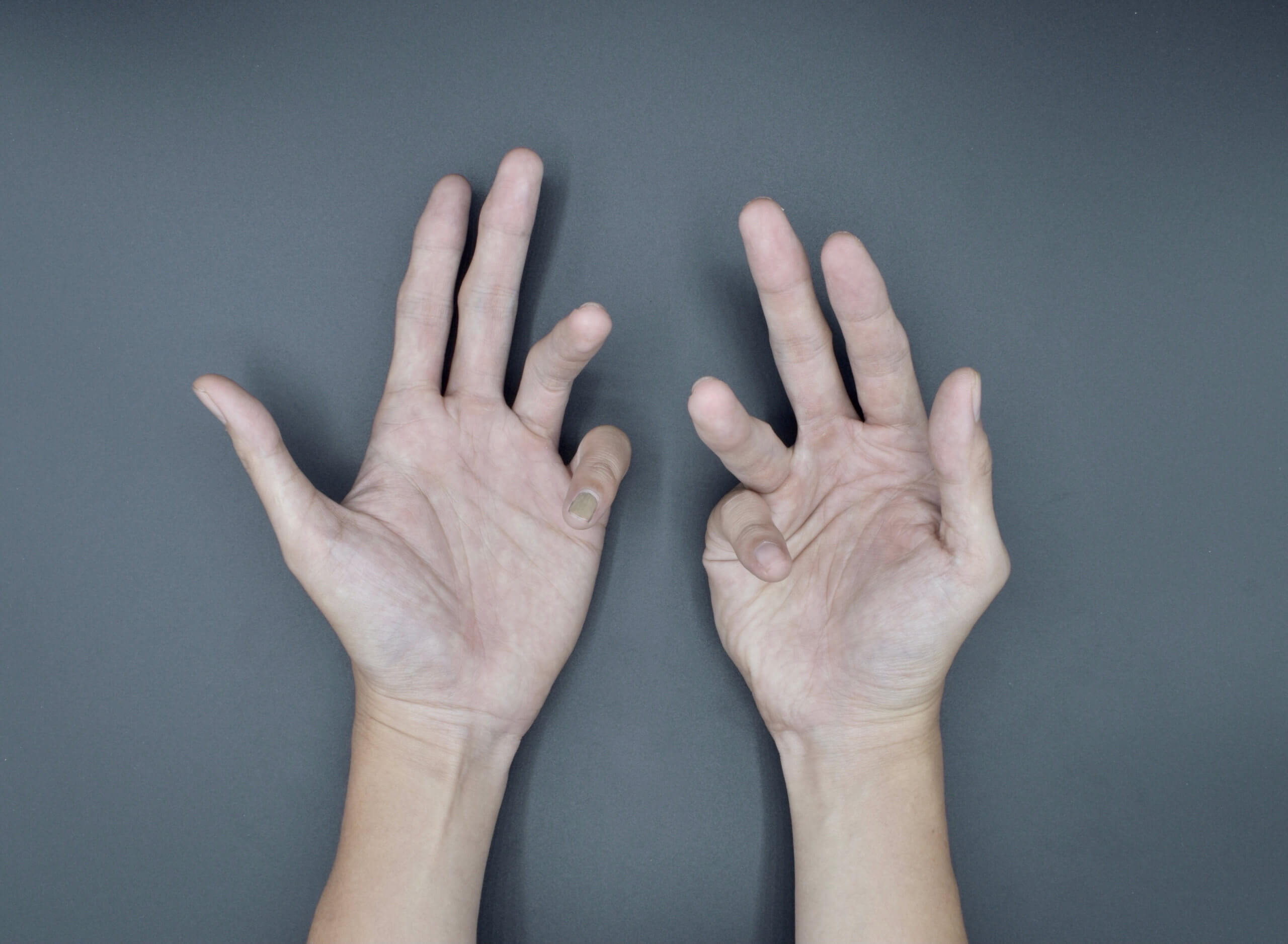 Palm-up view of hands with Dupuytren’s contracture.