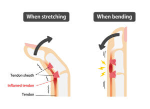 Medical illustration showing trigger finger tendon inflammation in the hand