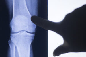 A physician points to the knee joint on a Xray in the orthopedic office. 