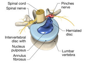 An illustrated diagram of a herniated spinal disc.