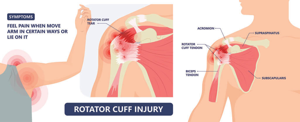 Diagram of the shoulder joint with symptoms of torn rotator cuff. 