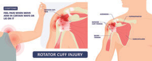 Diagram of the shoulder joint with symptoms of torn rotator cuff.