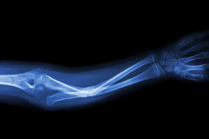 X-ray showing a broken ulnar bone in the forearm.