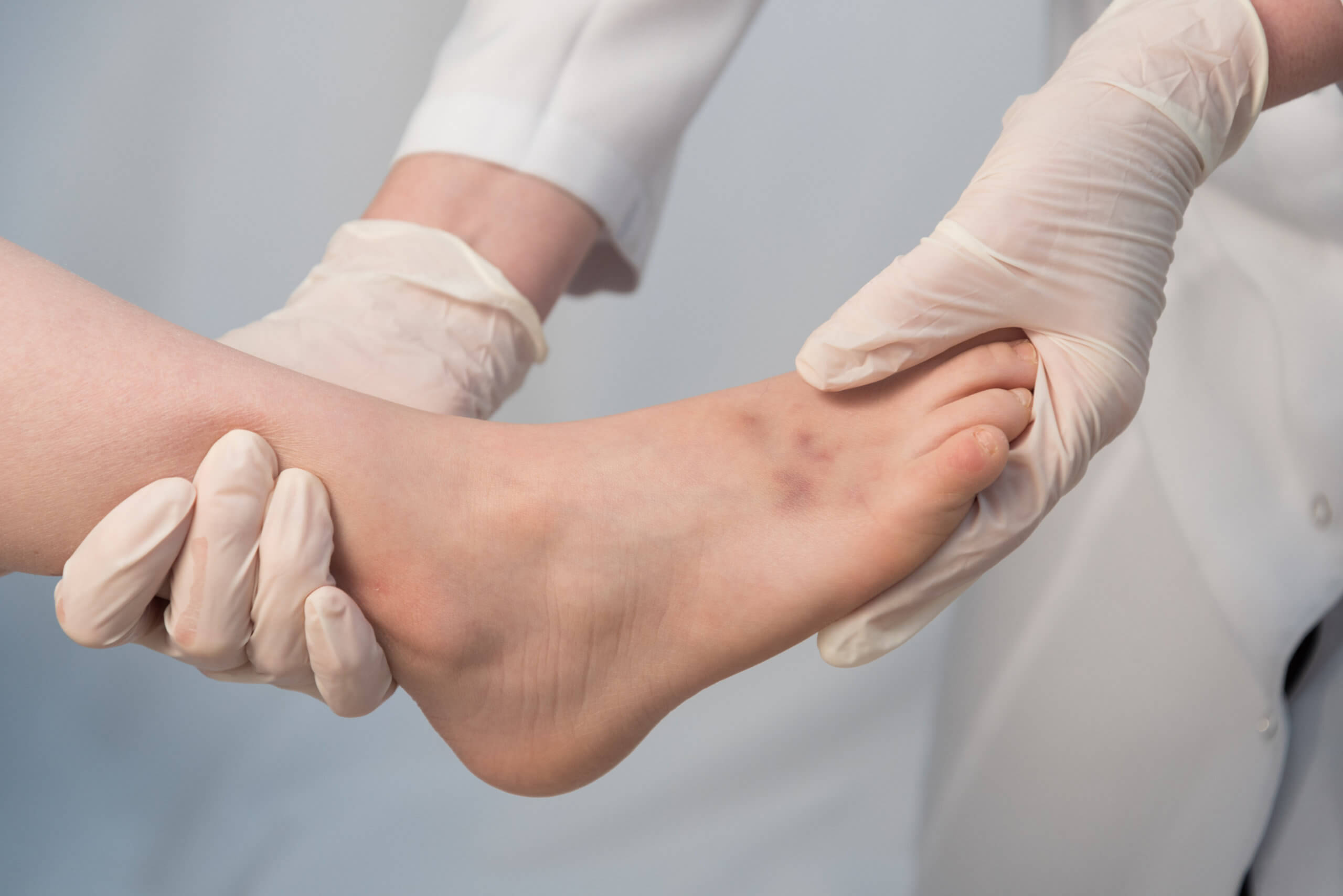 A doctor wears gloves while examining a foot with visible bruising.