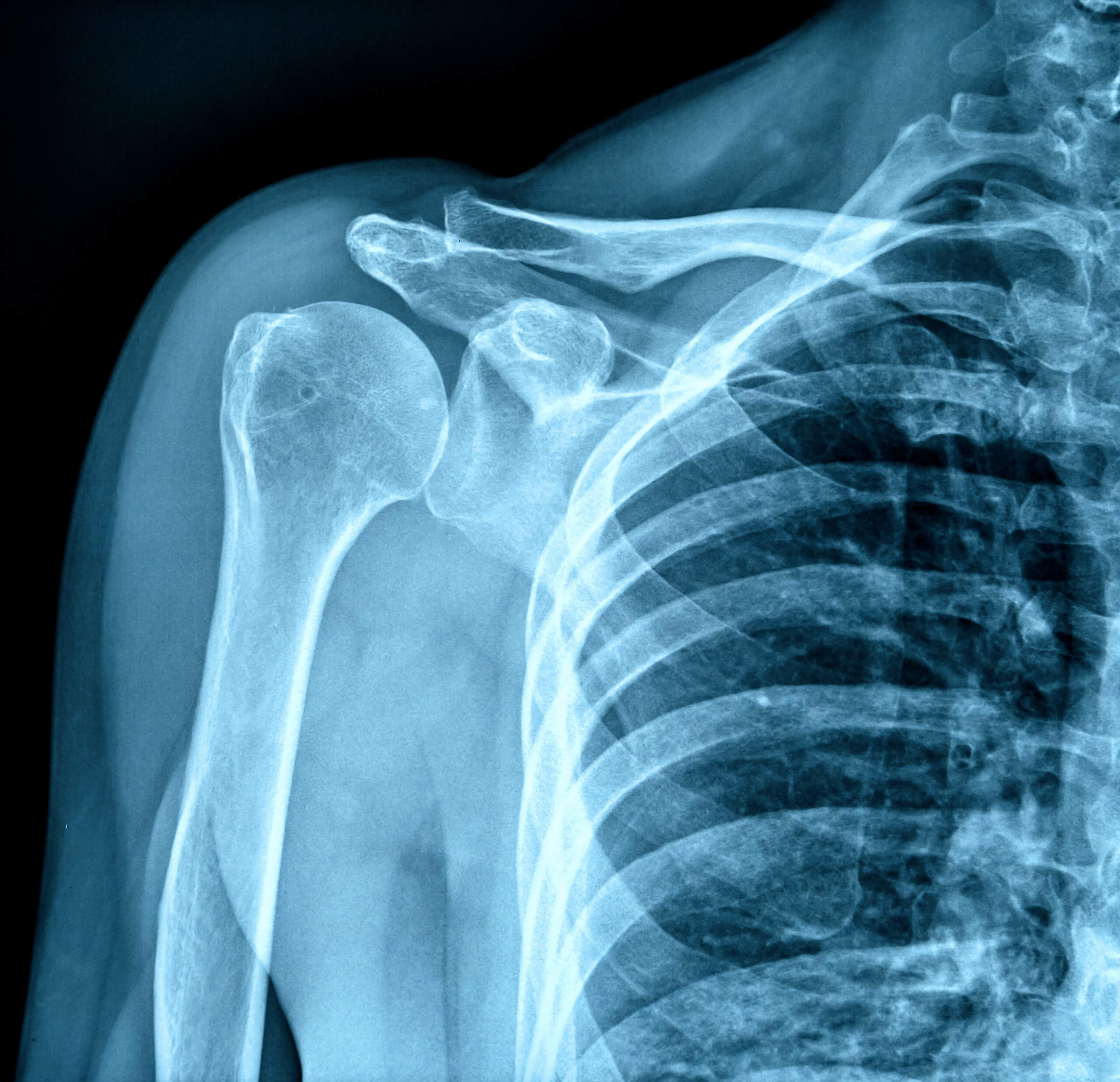 An X-ray of a patient’s shoulder