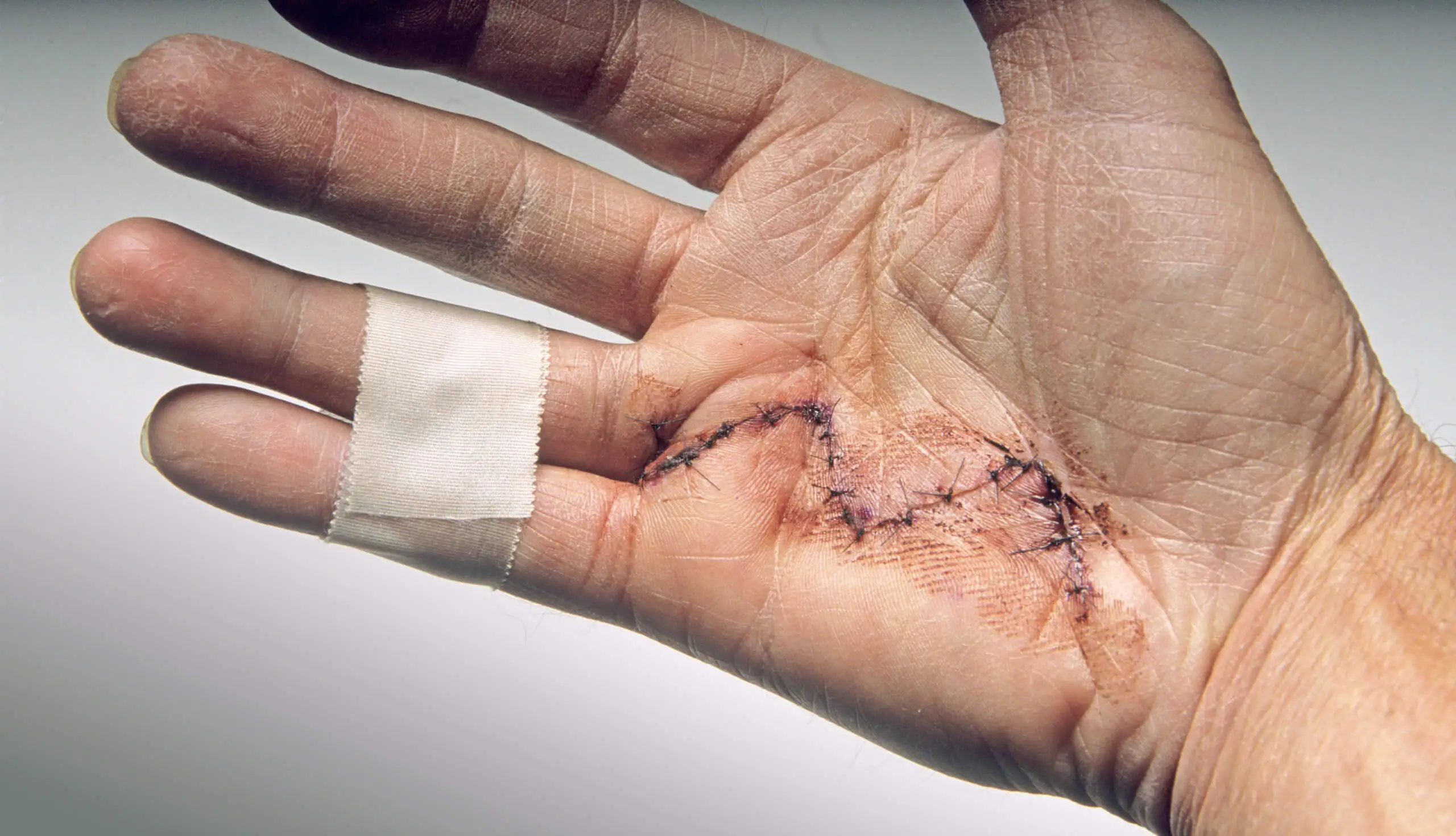 Close-up of a hand with the last two fingers taped together and stitches down the palm after surgery for Dupuytren’s contracture. 